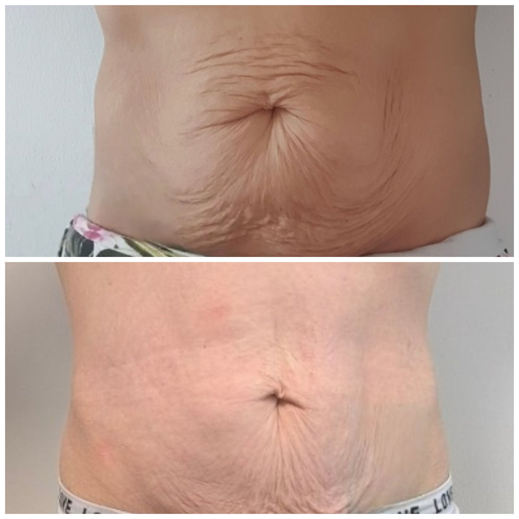 Premium Radiofrequenz Needling Schulung