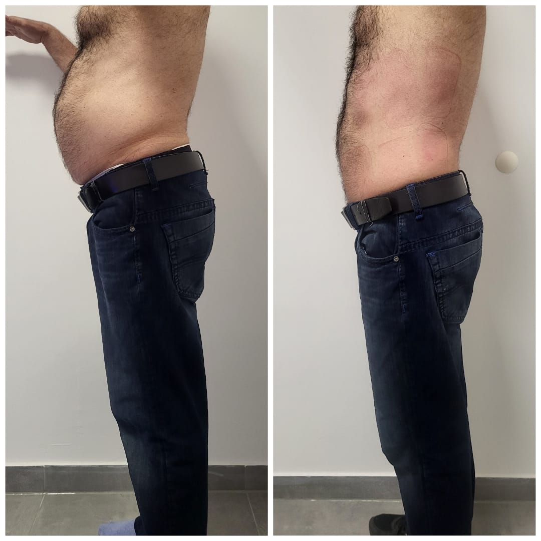 Summer body - Kur Aktion